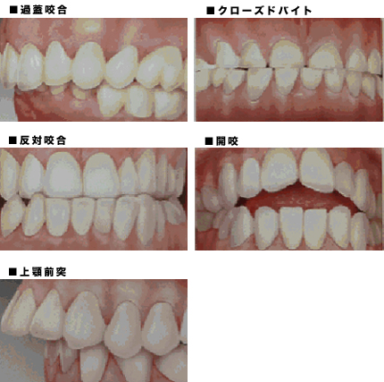 代表的な不正咬合