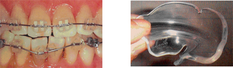 いろいろな矯正器具