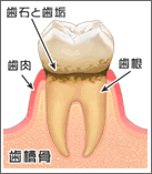 歯周病