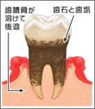 歯周病