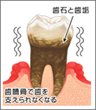 歯周病