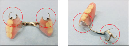 審美デンチャー