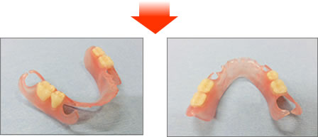 審美デンチャー