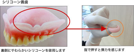 シリコーン義歯